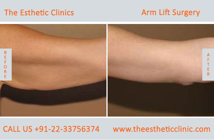 Arm Lift Surgery, Brachioplasty before after photos in mumbai india (2)